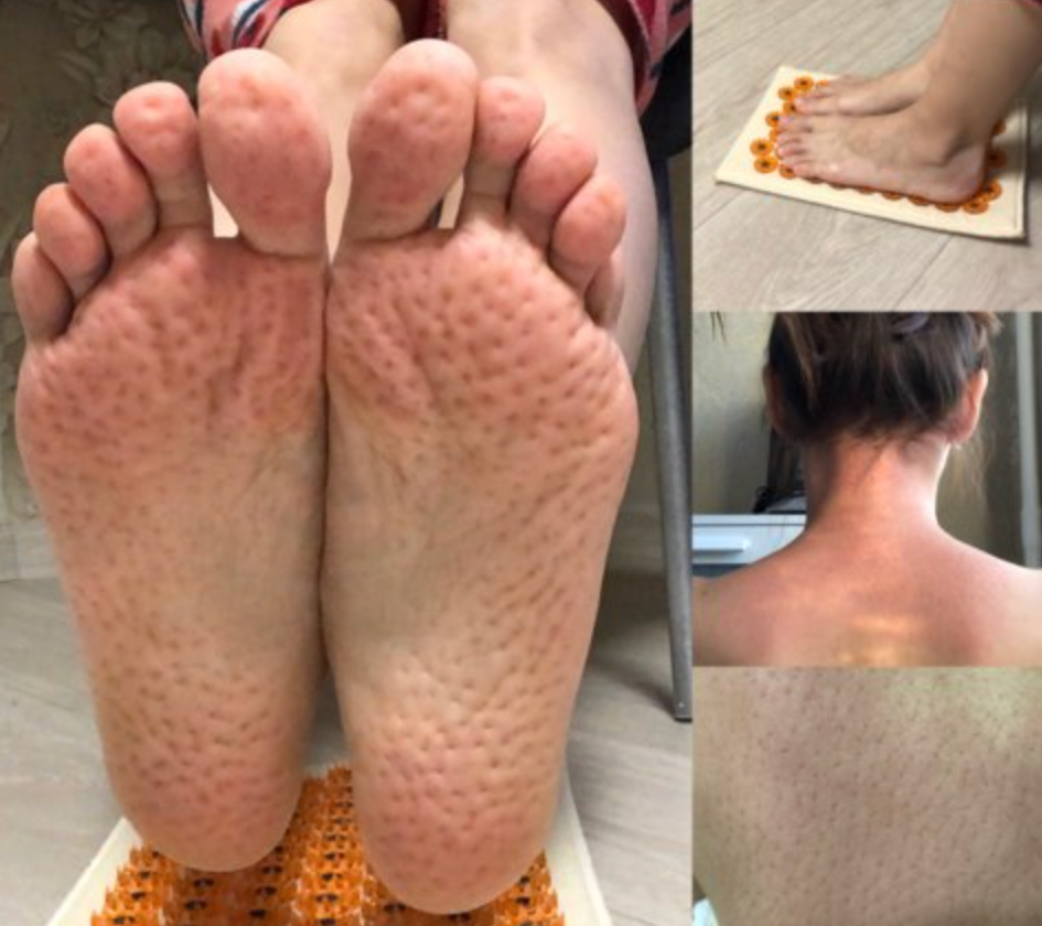 Dual Harmony™ Acupressure Mat (Kuznetsov's Applicator)